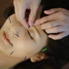 美容鍼